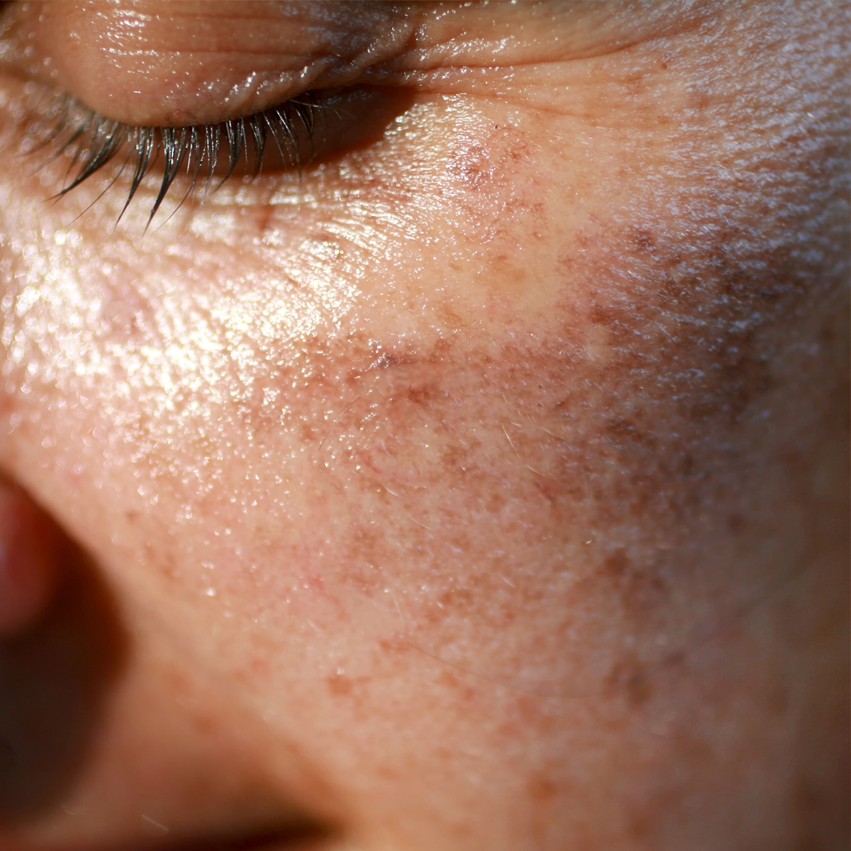 Hyperpigmentation Louis Widmer